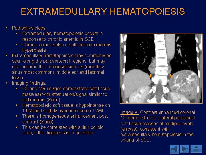 EXTRAMEDULLARY HEMATOPOIESIS • • • Pathophysiology: • Extramedullary hematopoiesis occurs in response to chronic
