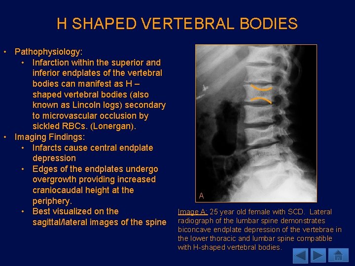 H SHAPED VERTEBRAL BODIES • Pathophysiology: • Infarction within the superior and inferior endplates