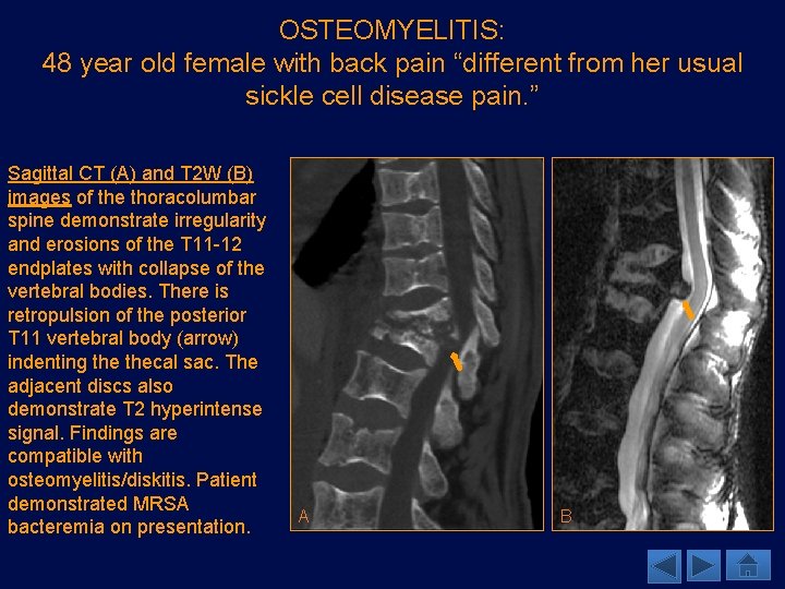 OSTEOMYELITIS: 48 year old female with back pain “different from her usual sickle cell