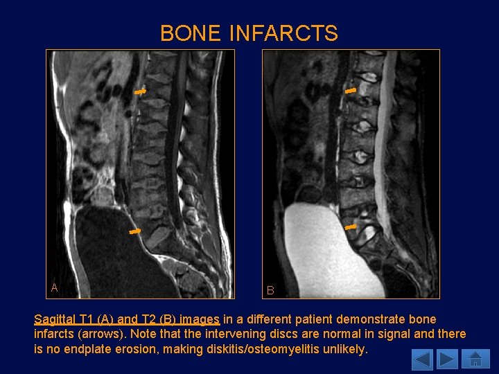 BONE INFARCTS A B Sagittal T 1 (A) and T 2 (B) images in