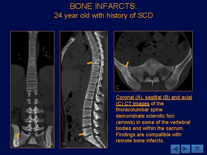 BONE INFARCTS: 24 year old with history of SCD C A B Coronal (A),