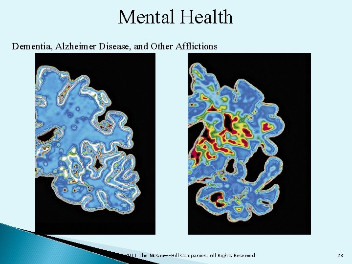 Mental Health Dementia, Alzheimer Disease, and Other Afflictions © 2011 The Mc. Graw-Hill Companies,