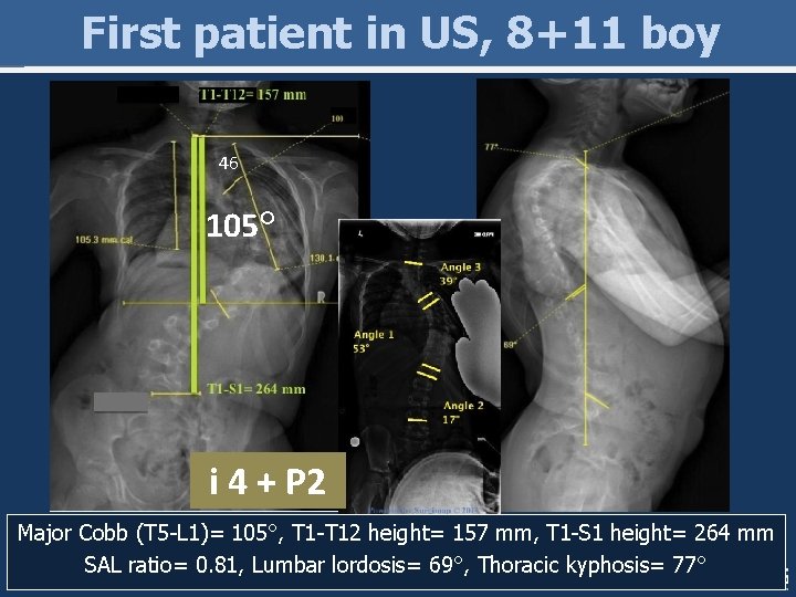 First patient in US, 8+11 boy 46 105° i 4 + P 2 Major First patient in US, 8+11 boy 46 105° i 4 + P 2 Major