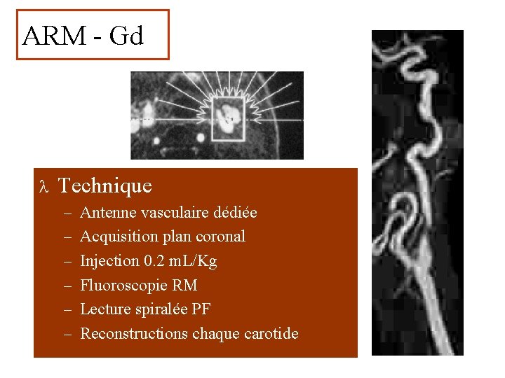 ARM - Gd l Technique – Antenne vasculaire dédiée – Acquisition plan coronal –