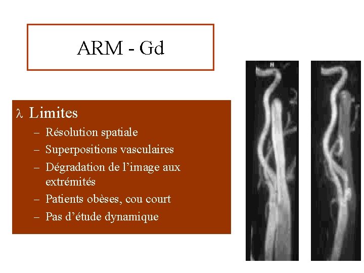 ARM - Gd l Limites – Résolution spatiale – Superpositions vasculaires – Dégradation de