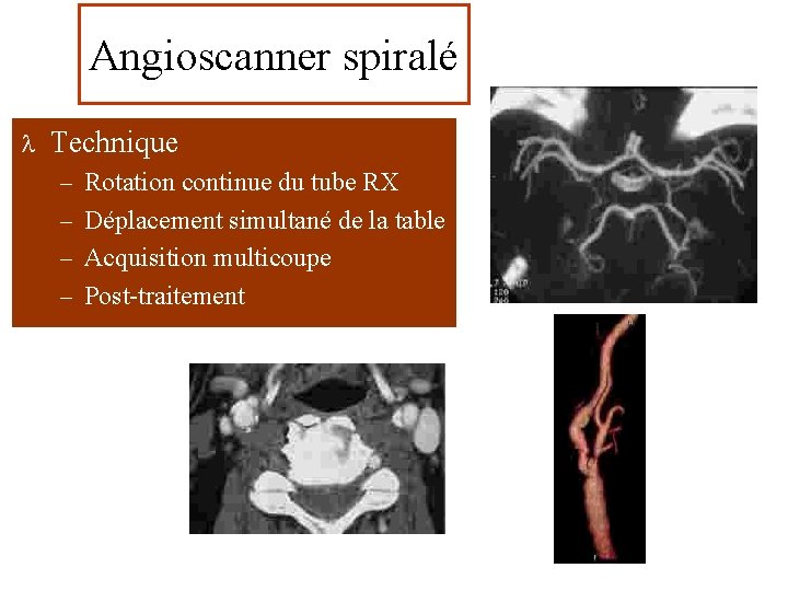 Angioscanner spiralé l Technique – Rotation continue du tube RX – Déplacement simultané de