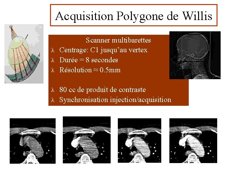 Acquisition Polygone de Willis Scanner multibarettes l Centrage: C 1 jusqu’au vertex l Durée