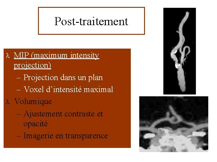 Post-traitement MIP (maximum intensity projection) – Projection dans un plan – Voxel d’intensité maximal