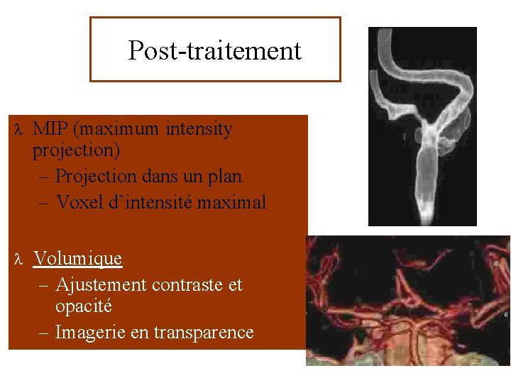 Post-traitement l MIP (maximum intensity projection) – Projection dans un plan – Voxel d’intensité