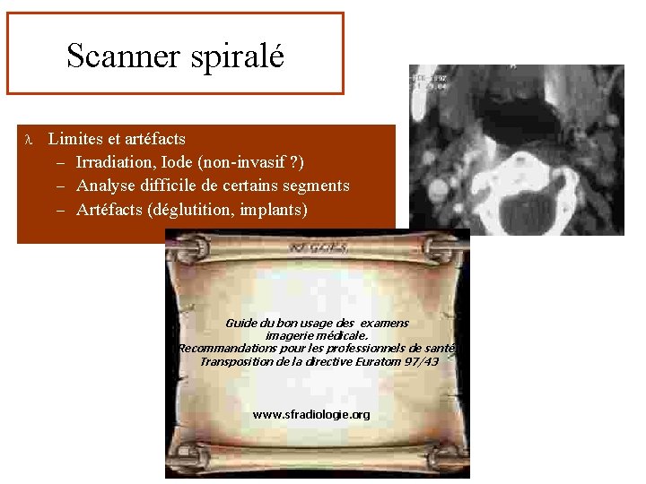 Scanner spiralé l Limites et artéfacts – Irradiation, Iode (non-invasif ? ) – Analyse