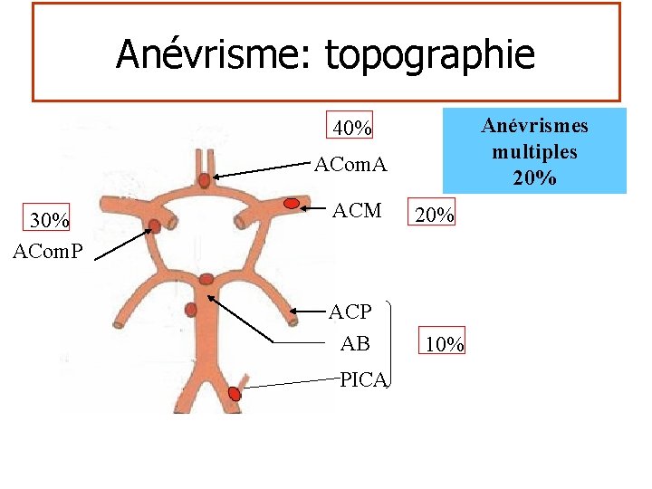 Anévrisme: topographie Anévrismes multiples 20% 40% ACom. A 30% ACom. P ACM ACP AB
