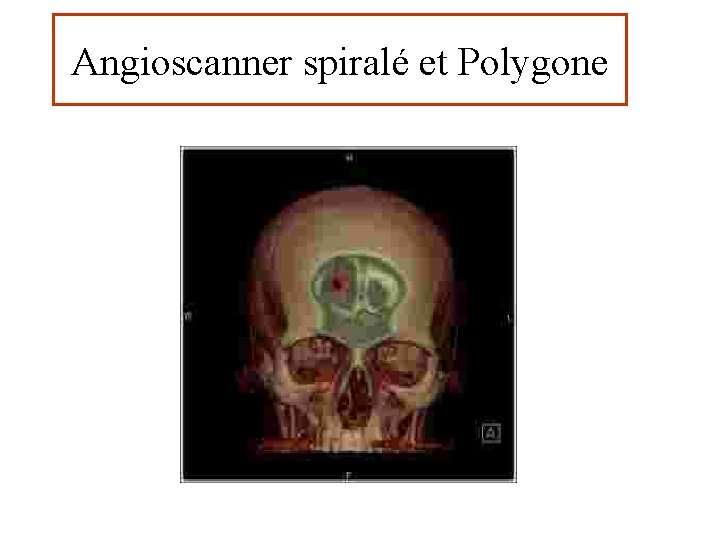 Angioscanner spiralé et Polygone Etude du polygone de Willis 