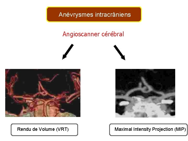 Anévrysmes intracrâniens Angioscanner cérébral Rendu de Volume (VRT) Maximal Intensity Projection (MIP) 