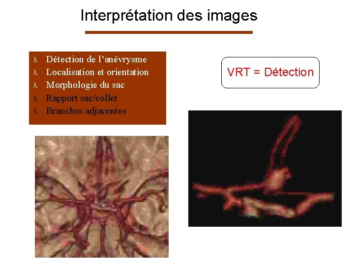 Interprétation des images l l l Détection de l’anévrysme Localisation et orientation Morphologie du