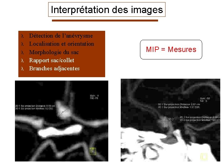 Interprétation des images l l l Détection de l’anévrysme Localisation et orientation Morphologie du