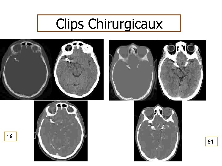 Clips Chirurgicaux 16 64 