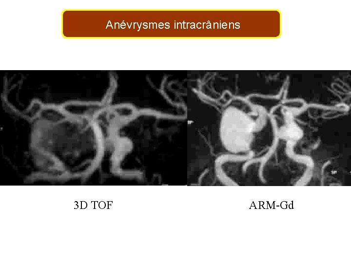 Anévrysmes intracrâniens 3 D TOF ARM-Gd 