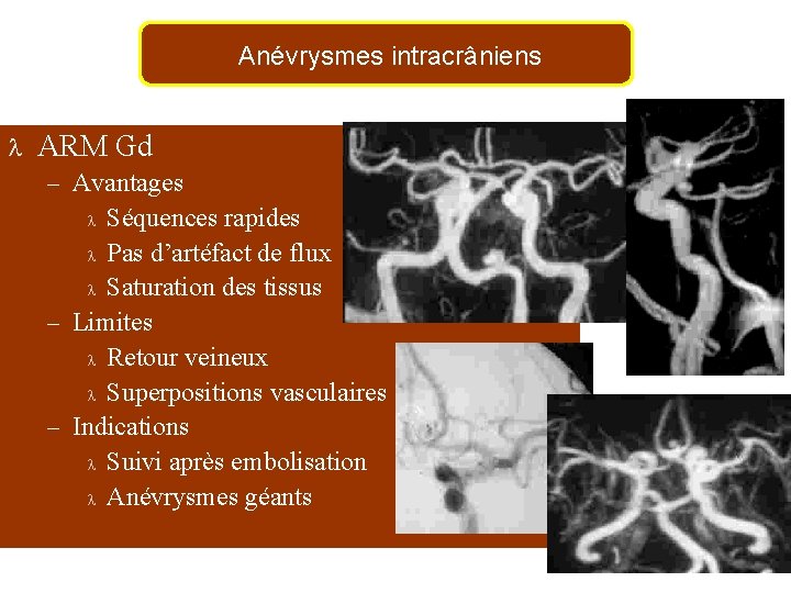 Anévrysmes intracrâniens l ARM Gd – Avantages Séquences rapides l Pas d’artéfact de flux