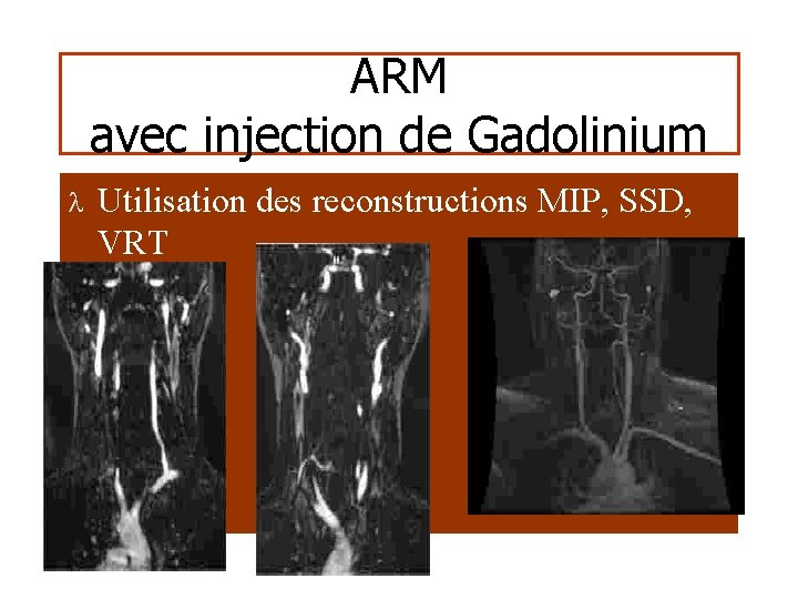 ARM avec injection de Gadolinium l Utilisation des reconstructions MIP, SSD, VRT 