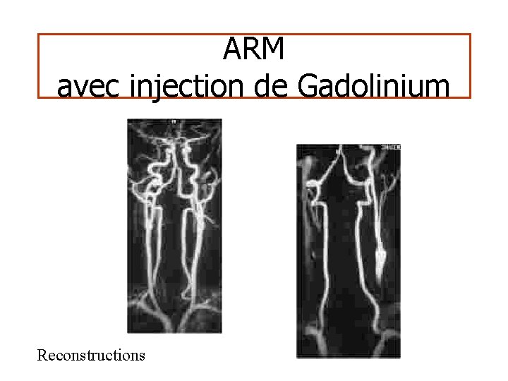 ARM avec injection de Gadolinium Reconstructions 