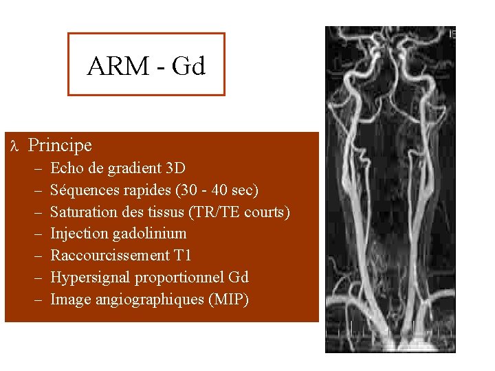 ARM - Gd l Principe – – – – Echo de gradient 3 D
