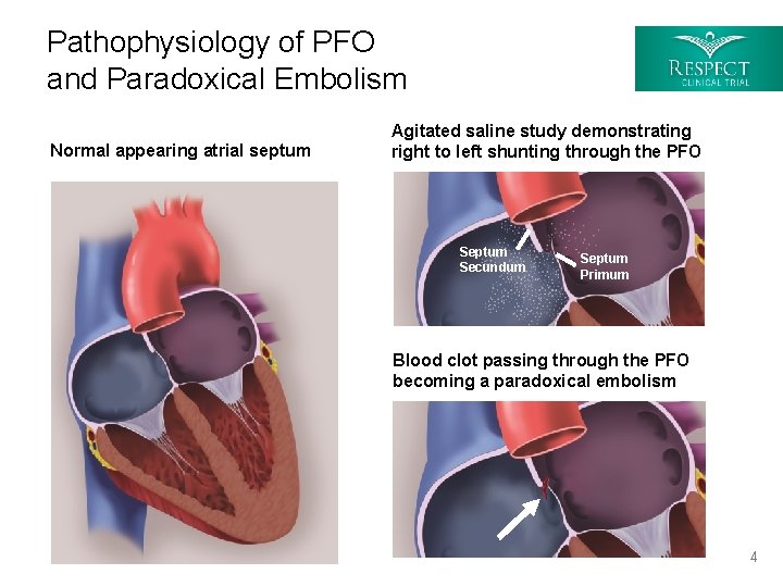 Pathophysiology of PFO and Paradoxical Embolism Normal appearing atrial septum Agitated saline study demonstrating