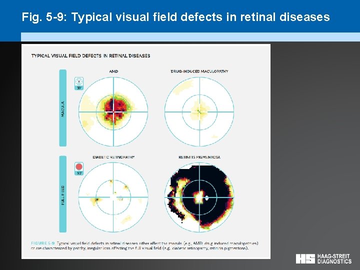 Fig. 5 -9: Typical visual field defects in retinal diseases 