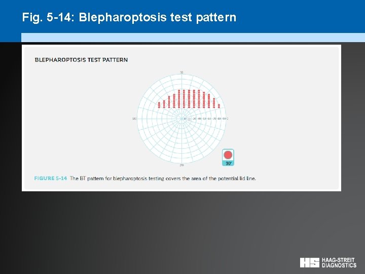 Fig. 5 -14: Blepharoptosis test pattern 