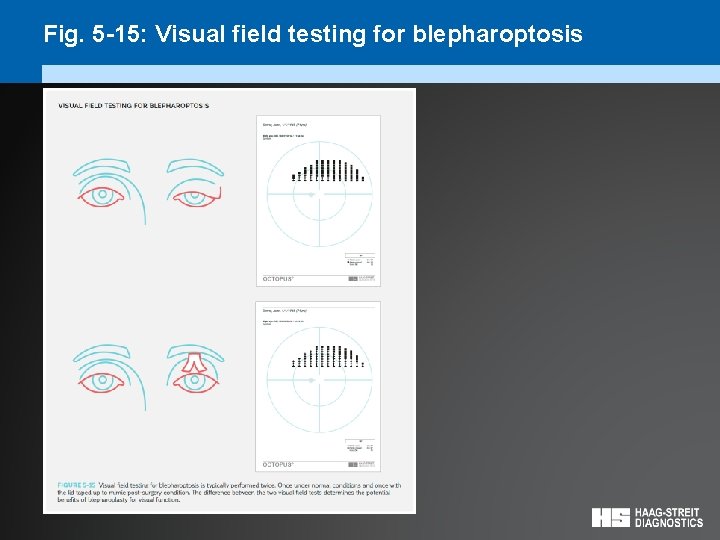 Fig. 5 -15: Visual field testing for blepharoptosis 