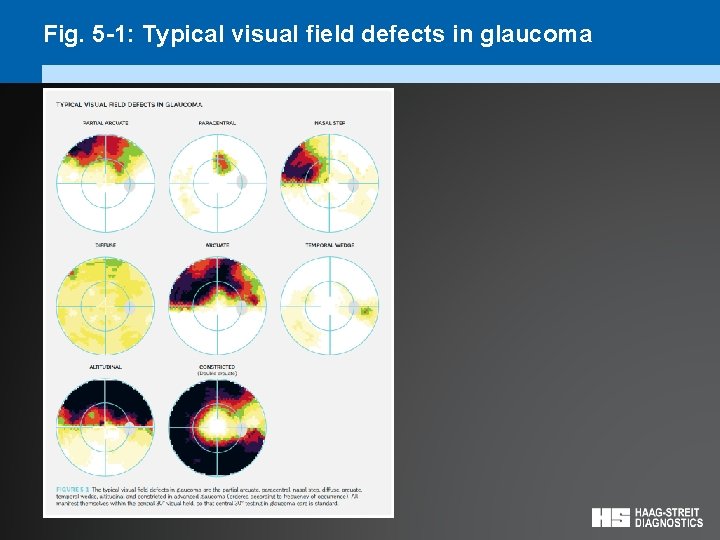 Fig. 5 -1: Typical visual field defects in glaucoma 