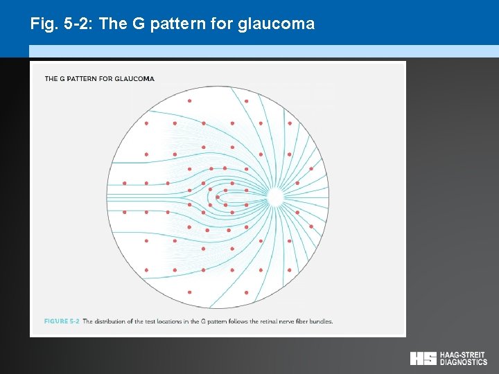Fig. 5 -2: The G pattern for glaucoma 