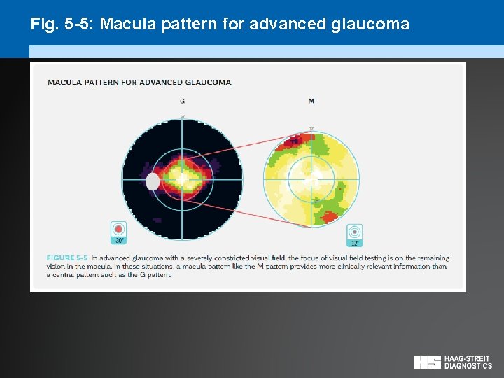 Fig. 5 -5: Macula pattern for advanced glaucoma 