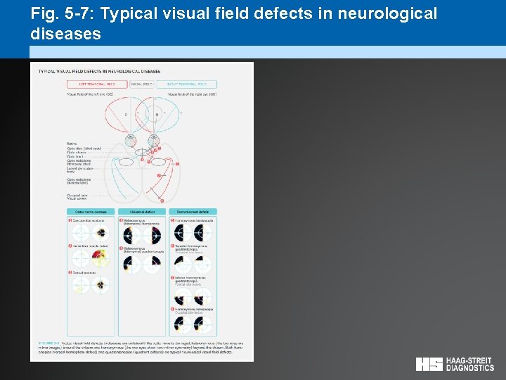 Fig. 5 -7: Typical visual field defects in neurological diseases 