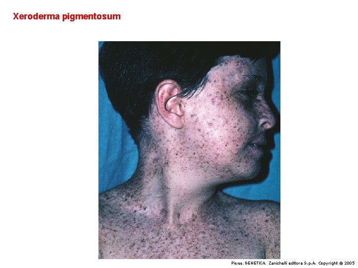 Xeroderma pigmentosum Pierce, GENETICA, Zanichelli editore S. p. A. Copyright © 2005 