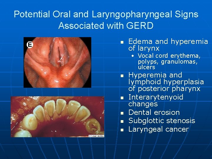 Potential Oral and Laryngopharyngeal Signs Associated with GERD n Edema and hyperemia of larynx