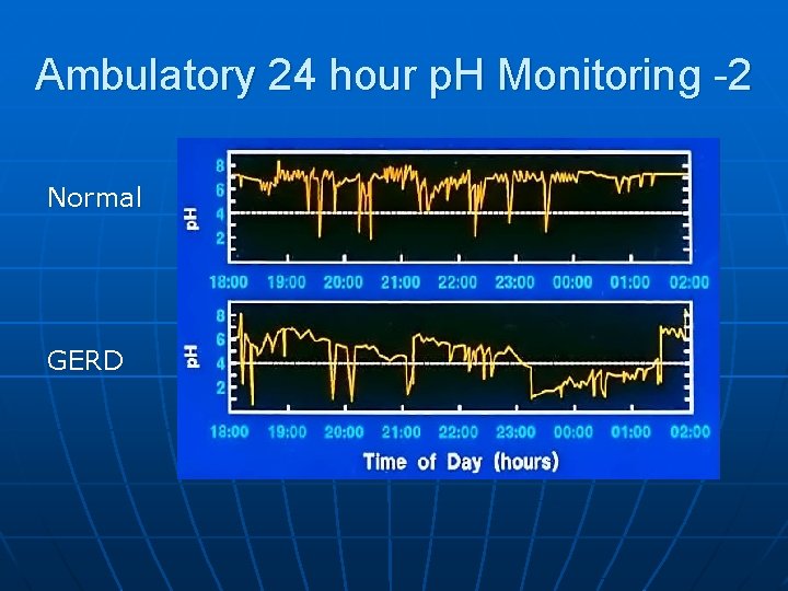 Ambulatory 24 hour p. H Monitoring -2 Normal GERD 