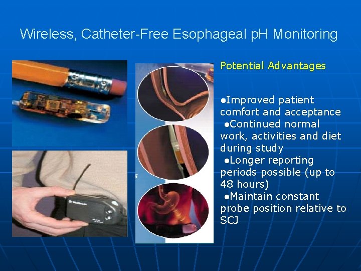 Wireless, Catheter-Free Esophageal p. H Monitoring Potential Advantages ●Improved patient comfort and acceptance ●Continued