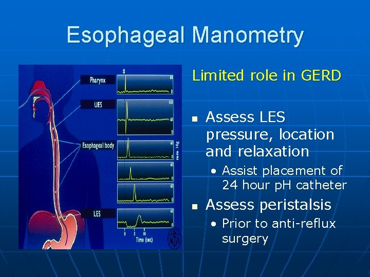 Esophageal Manometry Limited role in GERD n Assess LES pressure, location and relaxation •