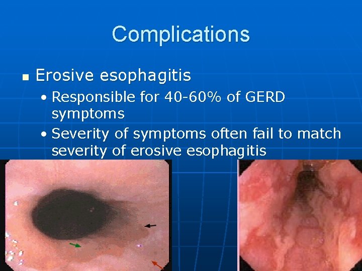 Complications n Erosive esophagitis • Responsible for 40 -60% of GERD symptoms • Severity