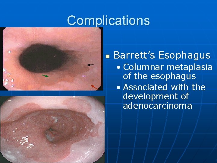 Complications n Barrett’s Esophagus • Columnar metaplasia of the esophagus • Associated with the