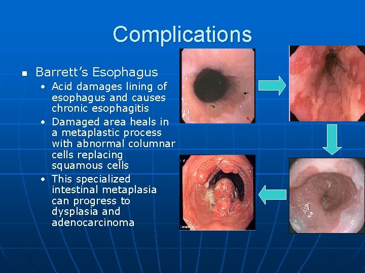 Complications n Barrett’s Esophagus • Acid damages lining of esophagus and causes chronic esophagitis