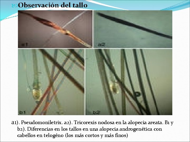  Observación del tallo a 1). Pseudomoniletrix. a 2). Tricorexis nodosa en la alopecia