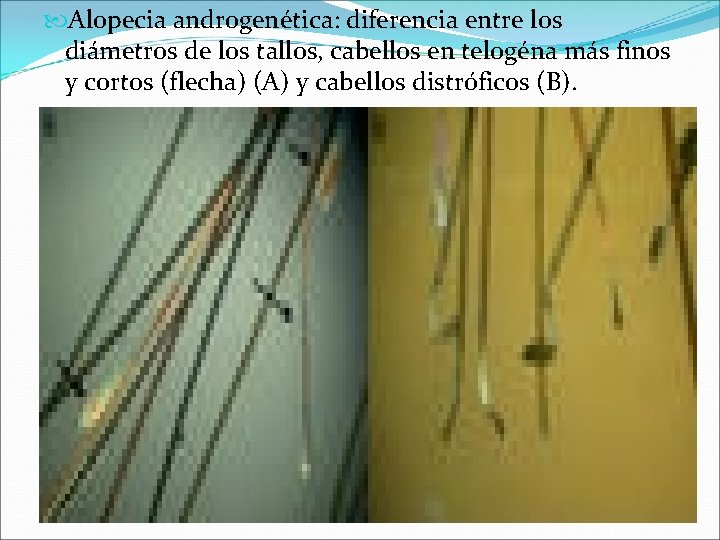  Alopecia androgenética: diferencia entre los diámetros de los tallos, cabellos en telogéna más