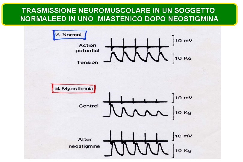 TRASMISSIONE NEUROMUSCOLARE IN UN SOGGETTO NORMALEED IN UNO MIASTENICO DOPO NEOSTIGMINA 