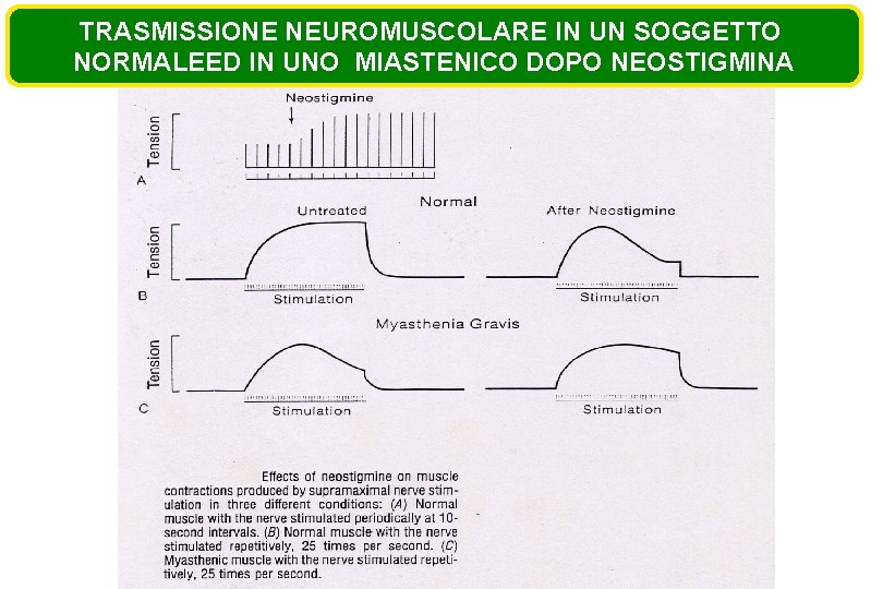 TRASMISSIONE NEUROMUSCOLARE IN UN SOGGETTO NORMALEED IN UNO MIASTENICO DOPO NEOSTIGMINA 