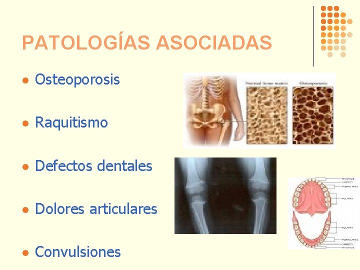 PATOLOGÍAS ASOCIADAS l Osteoporosis l Raquitismo l Defectos dentales l Dolores articulares l Convulsiones