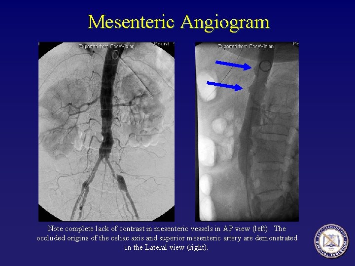 Mesenteric Angiogram Note complete lack of contrast in mesenteric vessels in AP view (left). Mesenteric Angiogram Note complete lack of contrast in mesenteric vessels in AP view (left).