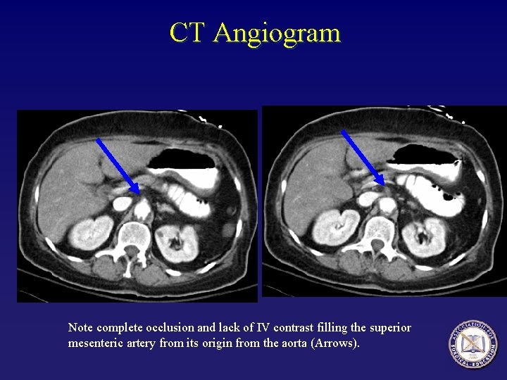 CT Angiogram Note complete occlusion and lack of IV contrast filling the superior mesenteric CT Angiogram Note complete occlusion and lack of IV contrast filling the superior mesenteric