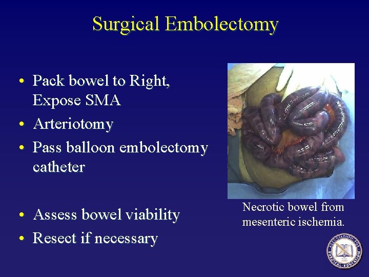 Surgical Embolectomy • Pack bowel to Right, Expose SMA • Arteriotomy • Pass balloon Surgical Embolectomy • Pack bowel to Right, Expose SMA • Arteriotomy • Pass balloon