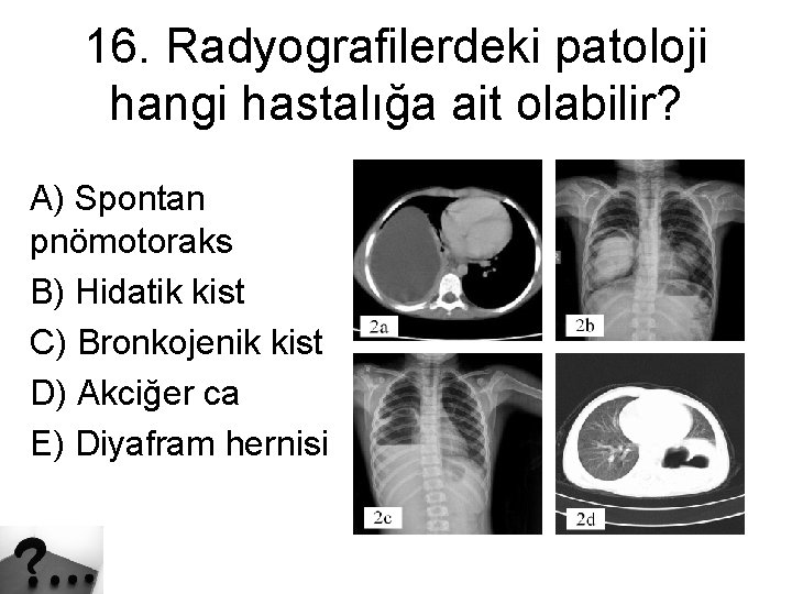 16. Radyografilerdeki patoloji hangi hastalığa ait olabilir? A) Spontan pnömotoraks B) Hidatik kist C)